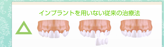 インプラントを用いない従来の治療法
