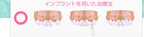 横須賀ワンラブデンタルのインプラントを用いた治療法