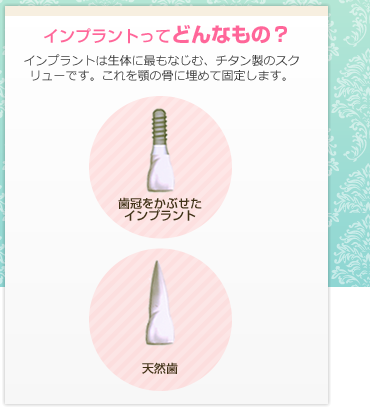 インプラントは生体になじむチタン製のスクリューです。これえお顎の骨に埋めて固定します。
