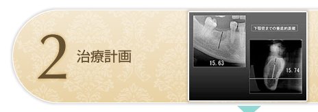 インプラント治療計画