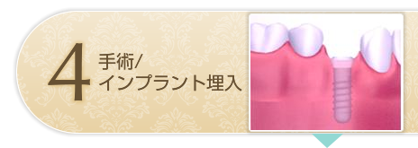 インプラント手術インプラント埋入